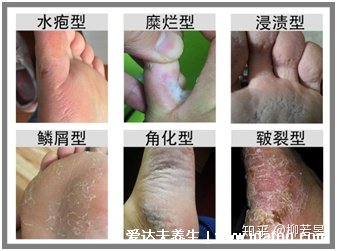 5種普通皮癬圖片早期癥狀，手蘚足蘚成人多見(甲蘚就是灰指甲)