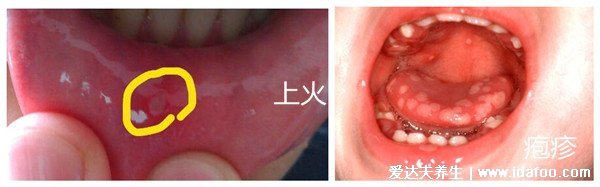 水泡和皰疹的區(qū)別圖片，皰疹會有身體癥狀(帶狀皰疹神經(jīng)痛)