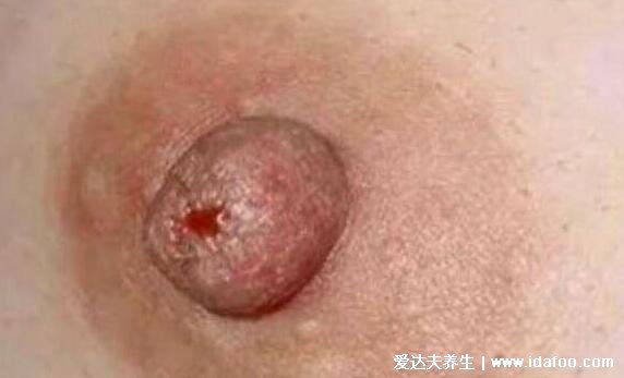 乳腺癌圖片大全早期癥狀真人，乳房有腫塊皮膚凹陷時要及時診治