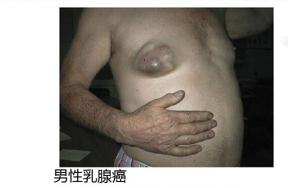 乳腺癌圖片大全早期癥狀真人，乳房有腫塊皮膚凹陷時要及時診治