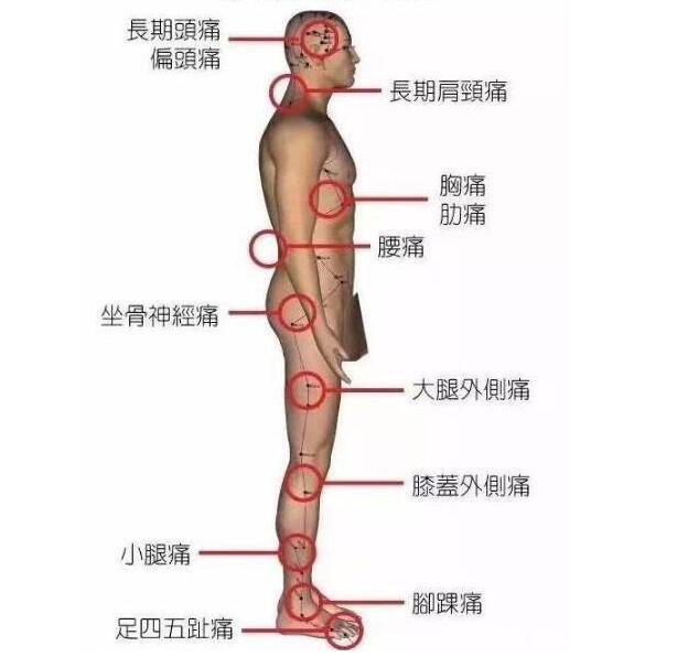 坐骨神經(jīng)痛的疼點(diǎn)圖，教你尋找痛點(diǎn)并消除疼痛(單側(cè)腰部到腳外側(cè))