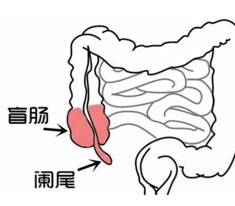 闌尾炎是哪個(gè)部位疼位置示意圖片，右下腹按壓痛(早期上腹肚臍疼)