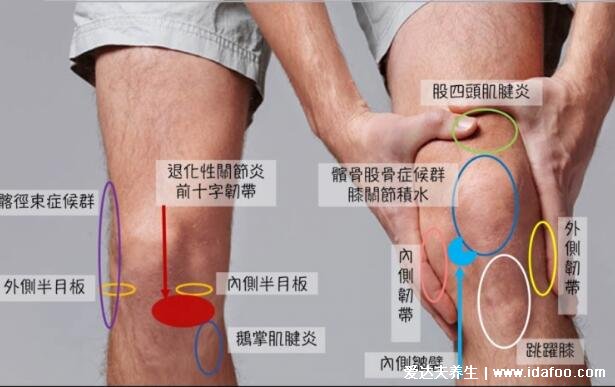 膝蓋疼痛是怎么回事?膝蓋各個(gè)部位疼痛圖解(兩側(cè)疼最嚴(yán)重)