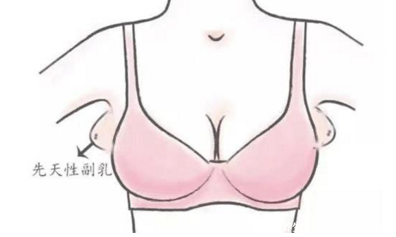 女人長副乳圖片，教你怎么判斷是副乳還是贅肉