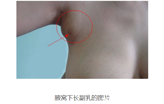 女人長副乳圖片，教你怎么判斷是副乳還是贅肉