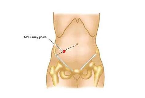闌尾在哪個位置？闌尾炎是哪個部位疼圖片，注意可轉移右下腹疼痛