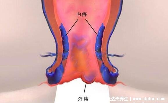 真實(shí)的外痔瘡圖片長(zhǎng)什么樣?能摸到肛門口有個(gè)肉球(附自愈方法)