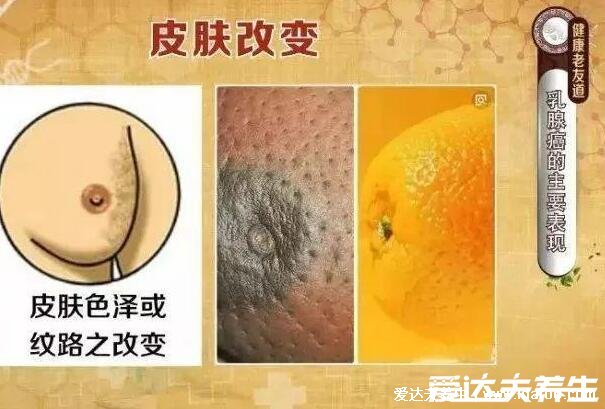 女性乳腺癌圖片早期癥狀，乳頭表面出現(xiàn)溢液要注意(乳房腫塊4大癥狀)