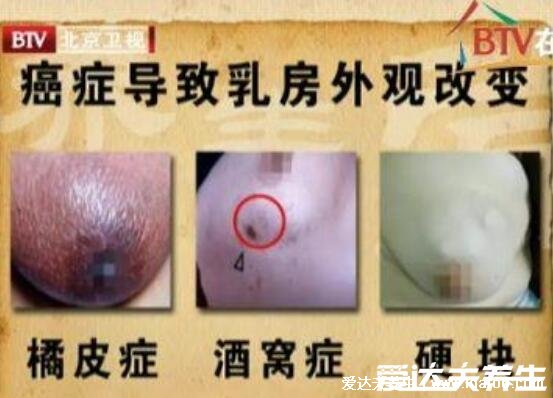 乳房癌癥的早期信號(hào)圖片，乳房腫塊早期可不疼痛(乳頭溢液顏色要注意)