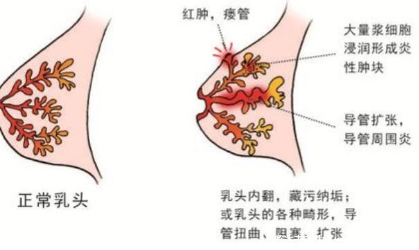 乳腺炎的癥狀表現(xiàn)有哪些癥狀圖片，哺乳期媽媽注意了有3大變化