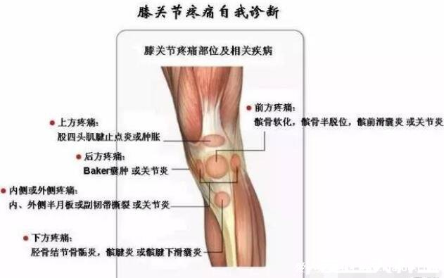 膝蓋疼痛可能有三種病，骨質增生易得關節(jié)炎(附膝蓋各個部位疼痛圖解)