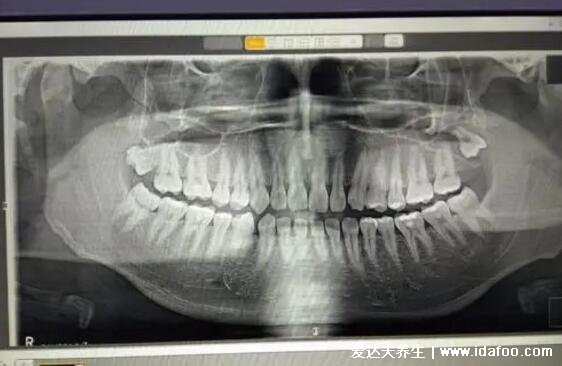拔智齒后遺癥太多了，4個危害讓你拔了智齒后悔終身