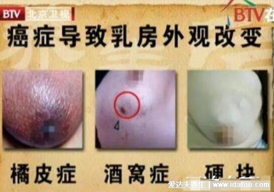 乳腺癌的15個征兆圖片，警惕乳房凹陷/乳頭溢液/腫塊/橘皮樣改變