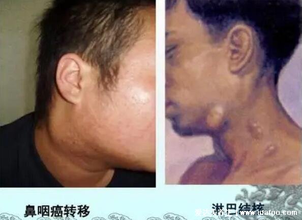 耳后淋巴結腫大圖片，不痛不癢質地堅硬的腫塊警惕鼻咽癌