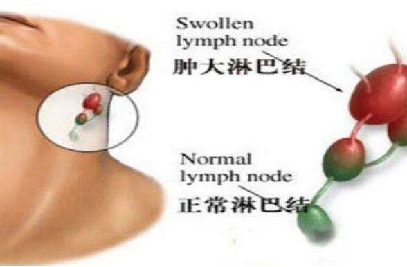 頸部淋巴結(jié)腫大圖片，脖子腫大是癥狀之一(引起原因有很多警惕淋巴瘤)