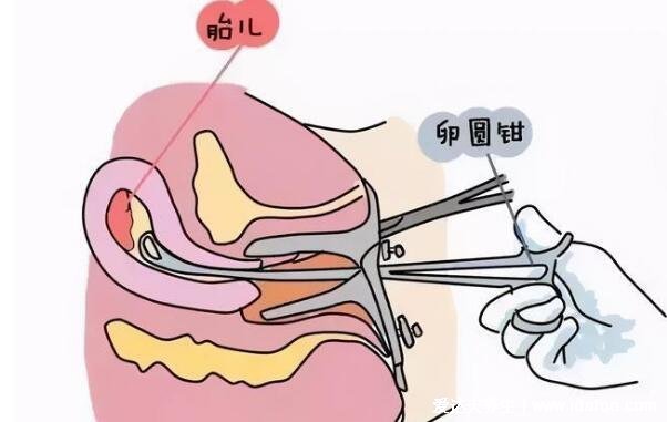 藥流和人流哪個(gè)恢復(fù)快，藥流對(duì)身體傷害小一些(當(dāng)心流不干凈)