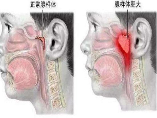 切除腺樣體后悔到家了，孩子遭罪家長心疼還有復(fù)發(fā)風險(但不做危害大)