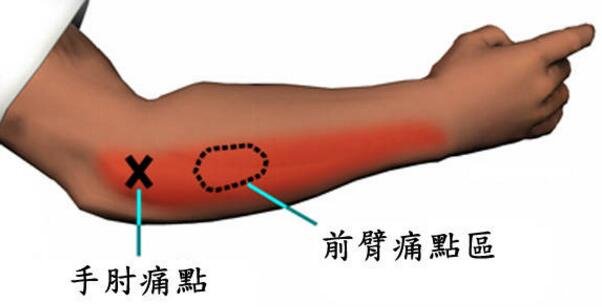 網(wǎng)球肘在哪個(gè)位置圖片，網(wǎng)球肘的按摩手法自我治療視頻圖解