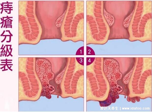 痔瘡長(zhǎng)什么樣子的圖片，含內(nèi)痔/外痔/混合痔圖片(混合痔主要發(fā)病形式)