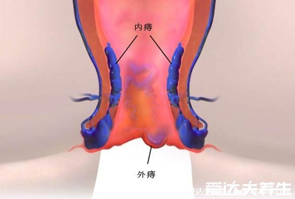 痔瘡長(zhǎng)什么樣子的圖片，含內(nèi)痔/外痔/混合痔圖片(混合痔主要發(fā)病形式)