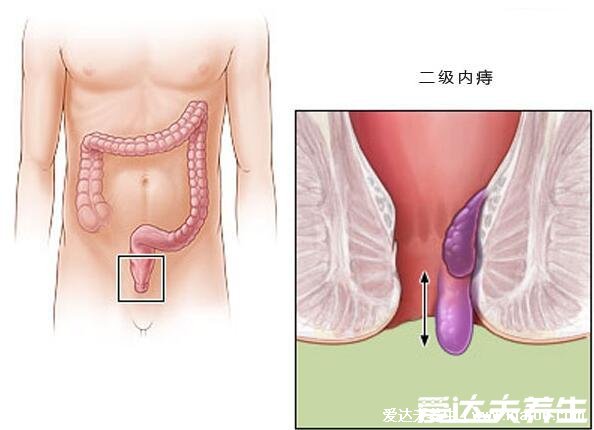 痔瘡長(zhǎng)什么樣子的圖片，含內(nèi)痔/外痔/混合痔圖片(混合痔主要發(fā)病形式)