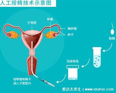 人工授精的過程與費(fèi)用，檢查費(fèi)用開始算起3000到5000元(附過程圖)