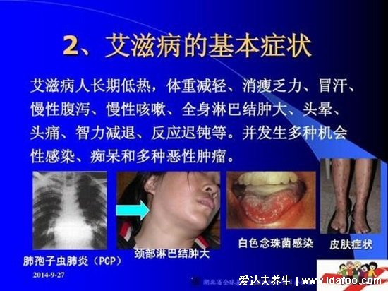 女人艾滋病的三大癥狀圖片，注意私處感染有分泌物/皰疹易糜爛