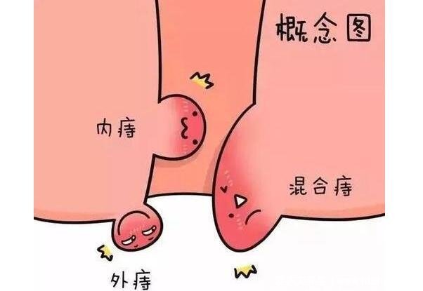 怎么判斷自己是不是長(zhǎng)了痔瘡，真實(shí)的輕微痔瘡圖片大全