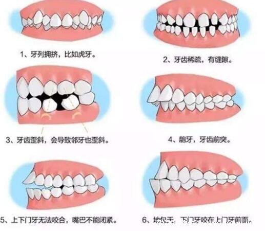 牙齒矯正最佳年齡段，12-18歲最佳可分為三個階段(無年齡限制)