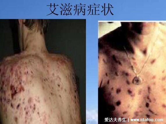 男性艾滋病的10個征兆，類似感冒癥狀易忽視(淋巴結腫大持續(xù)存在)