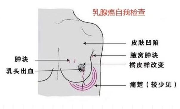 乳腺癌的15個征兆圖片，警惕乳房凹陷/乳頭溢液/腫塊/橘皮樣改變