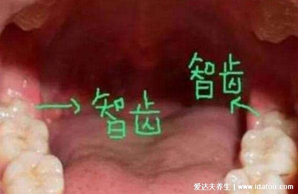 如何判斷自己長智齒了，28顆牙齒不可缺少多的是智齒(智齒可引起不適)