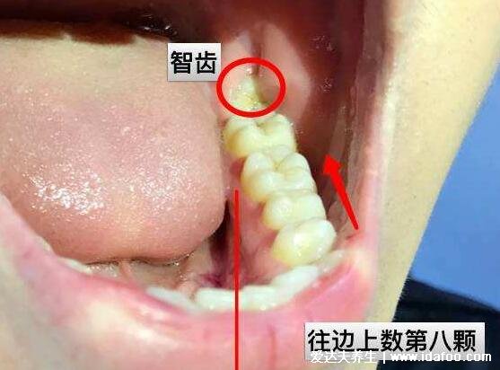 如何判斷自己長智齒了，28顆牙齒不可缺少多的是智齒(智齒可引起不適)