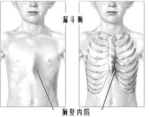 雞胸和正常人區(qū)別圖片，胸骨外凸大多佝僂病(嚴重可壓迫心臟) 