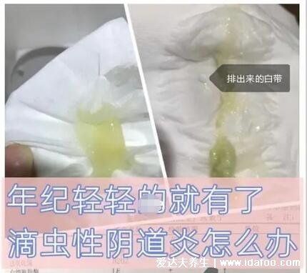 怎么判斷霉菌還是滴蟲圖片，霉菌豆腐渣樣白帶很瘙癢