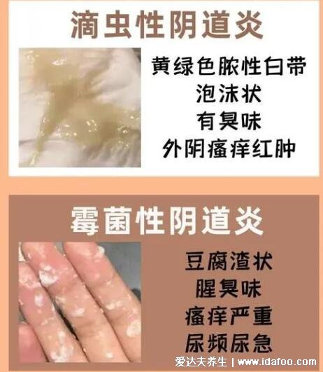 怎么判斷霉菌還是滴蟲圖片，霉菌豆腐渣樣白帶很瘙癢