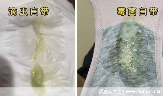 怎么判斷霉菌還是滴蟲圖片，霉菌豆腐渣樣白帶很瘙癢