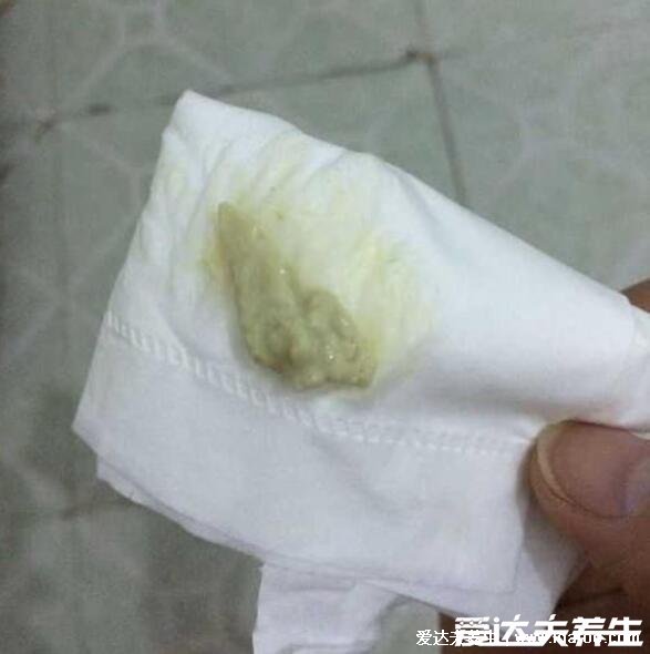 怎么判斷霉菌還是滴蟲圖片，霉菌豆腐渣樣白帶很瘙癢