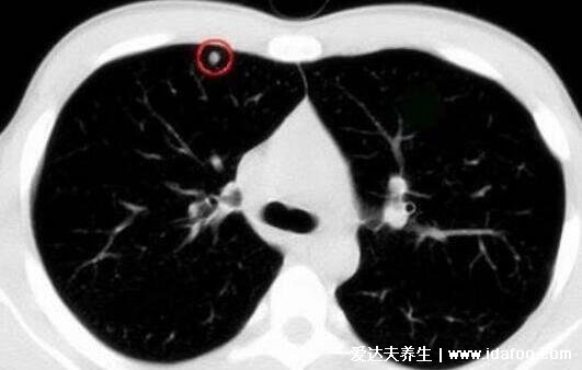 肺上結(jié)節(jié)80%是肺癌圖片，警惕生長速度很快的結(jié)節(jié)(95%是良性)