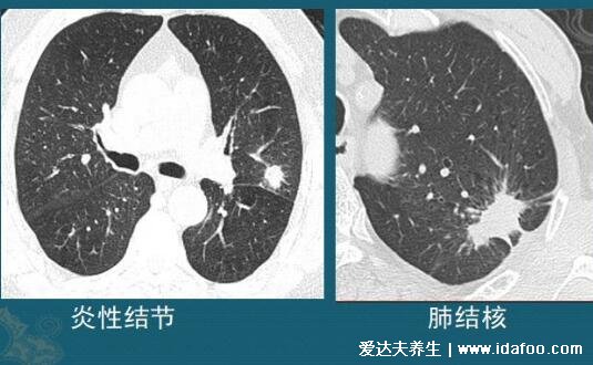 肺上結(jié)節(jié)80%是肺癌圖片，警惕生長速度很快的結(jié)節(jié)(95%是良性)