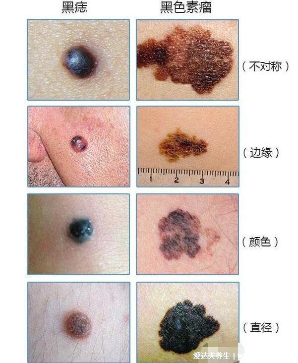 先天性巨痣圖片癌變幾率大嗎，黑痣直徑大于20厘米(2.8%會(huì)癌變)