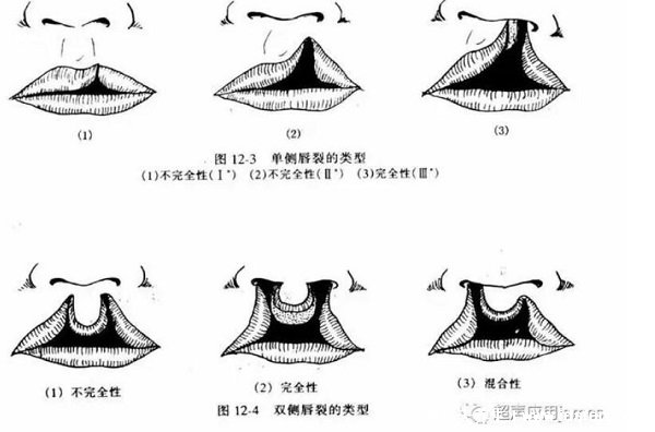 唇腭裂圖片是什么樣子圖片，1側或2邊嘴巴開裂(孕早期要預防)