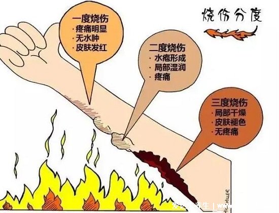 燒傷面積口訣三三三五六七，步步解析數(shù)字詳細(xì)意思(頭面頸3%) 