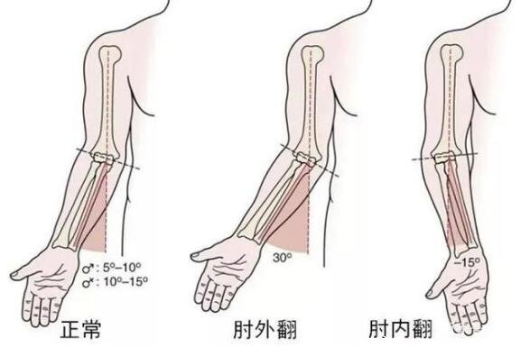 肘外翻圖片與正常胳膊對比，大于15度不符合征兵條件