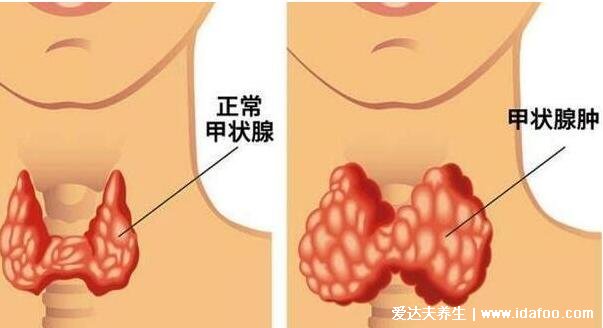 甲狀腺最怕2個水果，榴蓮/香蕉要慎吃加重甲狀腺結節(jié)