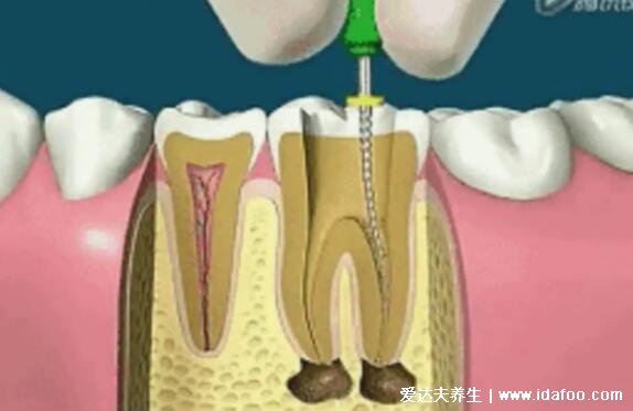 根管治療后悔一輩子，治療后不做牙冠隱患大/小心牙齒碎裂