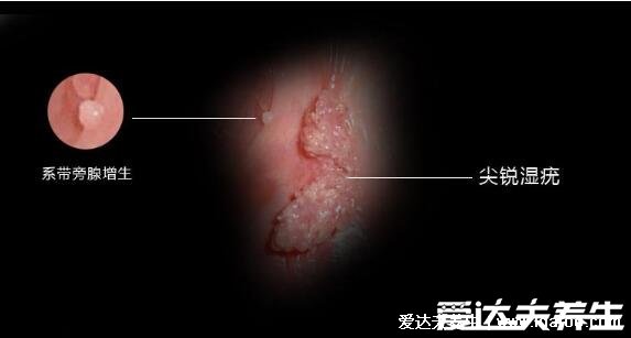 疣是什么樣子圖片，常見6種類型疣體(尋常疣/扁平疣/尖銳濕疣)