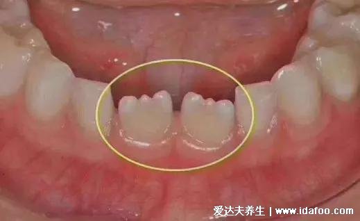 兒童換牙順序圖20顆，八歲兒童有幾顆牙(6歲開始恒牙替換乳牙)