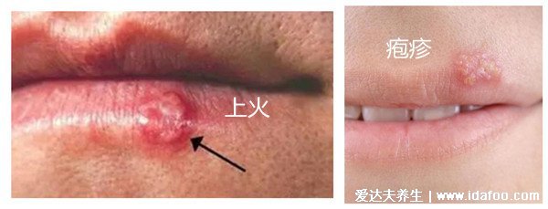 嘴上皰疹和上火水泡的區(qū)別圖，口唇皰疹成簇聚集會癢和灼熱