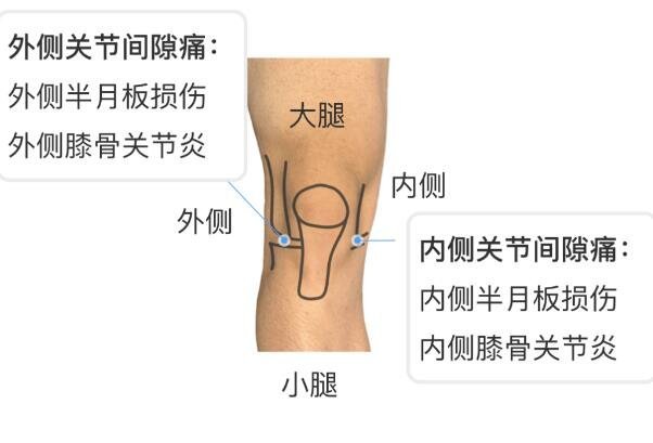 半月板是什么部位圖片，位于膝關節(jié)的內外兩側起緩沖作用